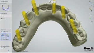 Fabrication of the BruxZir® FullArch Implant Prosthesis Vol 1 Issue 2 [upl. by Noella]