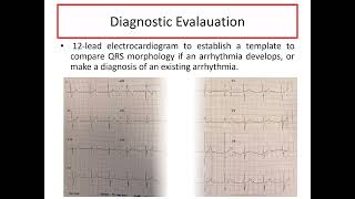 Early Postoperative Arrhythmias after pediatric cardiac surgery Dr Osama Abdelaziz [upl. by Bromleigh246]