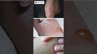 Diabetic Dermopathy  How diabetes affects your skin too diabetes skincare health [upl. by Ynnus]