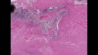 Histopathology Testis Embryonal carcinoma [upl. by Coshow]