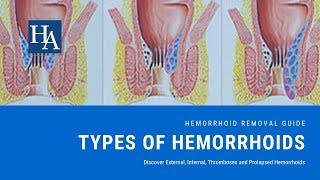 What Are Hemorrhoids Like Discover External Internal Thromboses and Prolapsed Hemorrhoids [upl. by Belle897]