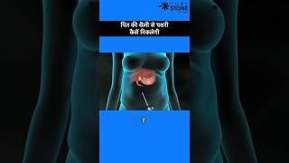 Gall bladder stone removal  Laproscopic Cholecystectomy  shortsviral [upl. by Anihta]