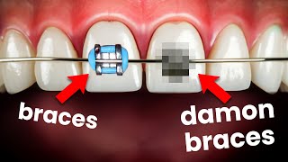 Traditional Braces vs Damon Braceswhich is better [upl. by Aiht]