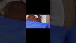 Molar implants 4 month post op osseointesratun  Tapping sound [upl. by Eelirem843]