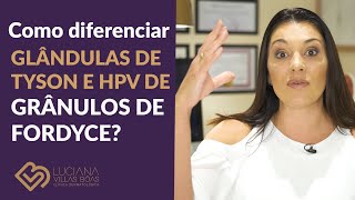 O que eu tenho é Glândulas de TYSON HPV ou Grânulos de FORDYCE [upl. by Assirat]