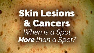 When is a Spot More than a Spot Skin Lesions and Cancers [upl. by Eluj952]