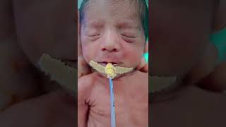 premature twins 1😍😍baby angel cute afterbirth [upl. by Llemert870]