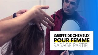 Greffe de cheveux femme sans rasage😮  Turkisme Medical [upl. by Noeled]