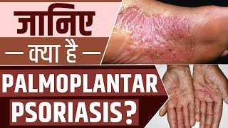 Palmoplantar Psoriasis के लक्षण और इसके उपचार  Psoriasis Specialist Care PsoriasisCareSpecialists [upl. by Minna387]