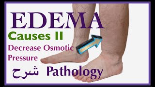 Pathology  Edema causes Decrease Osmotic Pressure  👨🏻‍⚕️ شرح باثو [upl. by Neirb]