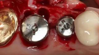 Immediate implantation  Implant advanced [upl. by Neidhardt]