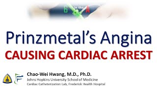 Prinzmetals Angina causing Cardiac Arrest [upl. by Cirtemed]