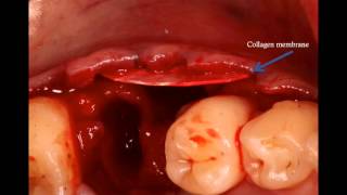 How to handle the missing buccal plate Surgical Master Instant Replay [upl. by Doralia193]