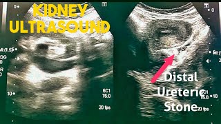 How to Renal Ultrasound  Hydronephrosis Hydroureter Distal Ureteral Stone [upl. by Aihsenod]