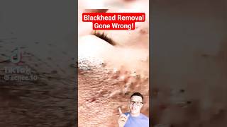 TERRIBLE BLACKHEAD REMOVAL  Shocked At This One shorts [upl. by Hafital]