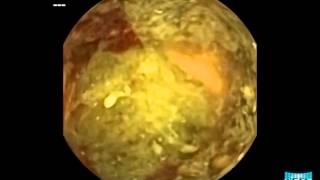 Small Bowel Capsule Endoscopy Visualizing Colonic Adenocarcinoma [upl. by Vitus905]