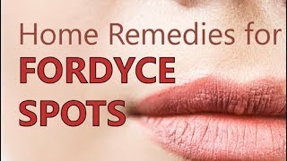 Home Remedies for Fordyce Spots  Treatment Methods Natural Cure [upl. by Ogilvy]