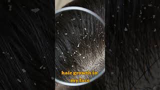 The Side Effects I Have Noticed After Using Minoxidil For One Year [upl. by Asila]