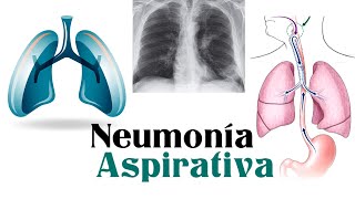 Neumonía Aspirativa Rápido y Fácil [upl. by Salita]