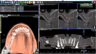 Digitalno planiranje implantata  Poliklinika Medikadent [upl. by Rosane]