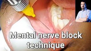 Local Anesthesia Mental Nerve block technique mandibular anesthesia Techniques dentistry [upl. by Caldera]