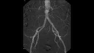 arteriografía abdominal [upl. by Yerocaj]