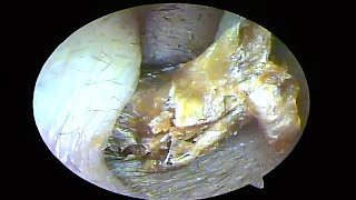 Remove two large cerumen plugs and dry fungus pieces from the ears and clean them（20241025） [upl. by Esemaj667]