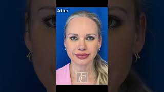 Facial rejuvenation through endoscopic brow lift and midface lift beforeandafte [upl. by Akinnej740]