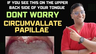 Dr Rudra If you see this on the upper back side of your tongue DONT WORRY Circumvallate Papillae [upl. by Roti]