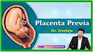 Placenta Previa Etiology Pathophysiology Clinical presentation Diagnosis and Treatment [upl. by Laon18]