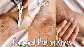 My TCA 25 Chemical Peel Journey Pt2 Chemical Peel on knees  TCA chemical peel chemicalpeeling [upl. by Prasad177]