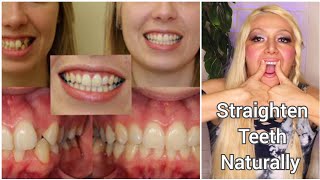 How To Straighten Teeth Naturally Exercises for Crooked Overjet Overbite Buck Teeth No Braces [upl. by Ydnelg]