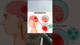 Meningitismedicine healthtips mbbs physiologyhealth healthcaresymptoms treatmentmeningitis [upl. by Aninahs]