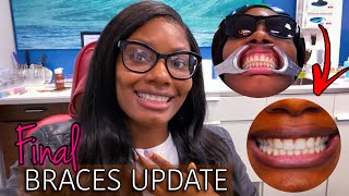 Final Braces Update  Permanent Retainer  Cleaning  Teeth Whitening  Starring Shameka [upl. by Trista]