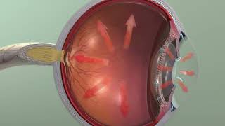 Animation Glaucoma [upl. by Mighell]