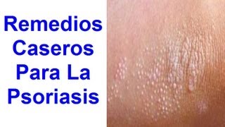 Qué es y como curar la Psoriasis con Remedios Naturales [upl. by Raines]