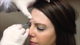 Allergan Botox Injections [upl. by Ahseenyt563]