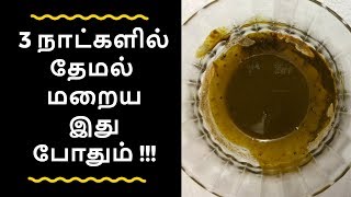 Themal skin disease I themal maraiya tips in tamil I themal poga tips in tamil I தேமல் மறைய [upl. by Leinahtan]