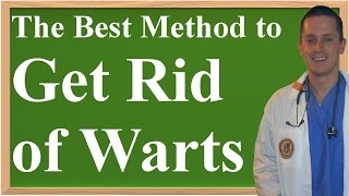 The Best Method to Get Rid of Warts at Home [upl. by Berta]