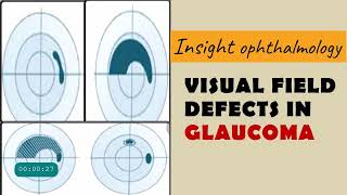 FIELD DEFECTS IN GLAUCOMA  arcuate paracentral nasal step temporal wedge baring of blindspot [upl. by Farnham]