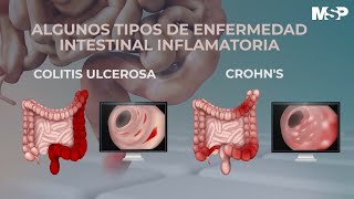 ¿Cómo tratar las enfermedades inflamatorias del intestino  ExclusivoMSP [upl. by Goer]