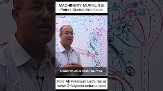 MACHINERY MURMUR In Patent Ductus Arteriosus shortvideo shorts drnajeeb lecture [upl. by Enaamuj445]