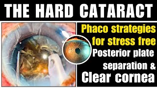 The hard cataract  Phaco strategies for stress free posterior plate separation amp Clear cornea [upl. by Aneertak]