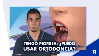 ¿Puedo ponerme ORTODONCIA si tengo PERIODONTITIS o me FALTAN DIENTES  Shorts [upl. by Neehahs]