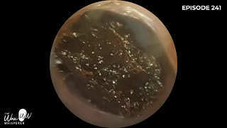 241  Ear Wax Removal in Stenotic Ear Canal using the WAXscope®️ [upl. by Rotsen]