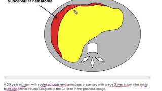 AAST Liver Injury Scale [upl. by Catherine200]