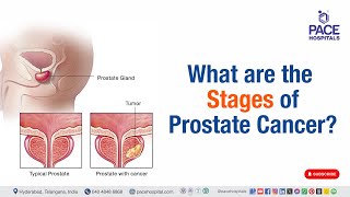 Stages of Prostate Cancer  What are the stages of prostate cancer  prostatecancer [upl. by Sibella]