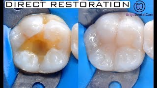 Replacing Amalgam  Direct Restoration Class I Composite [upl. by Ellord]