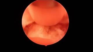 Minimally Invasive Spine Surgery Technique Direct Visual Rhizotomy [upl. by Nilson]