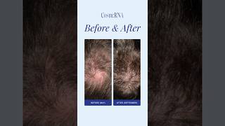 Revolutionary Antihair loss tonic beforeamp after cosmerna [upl. by Nuahsed]